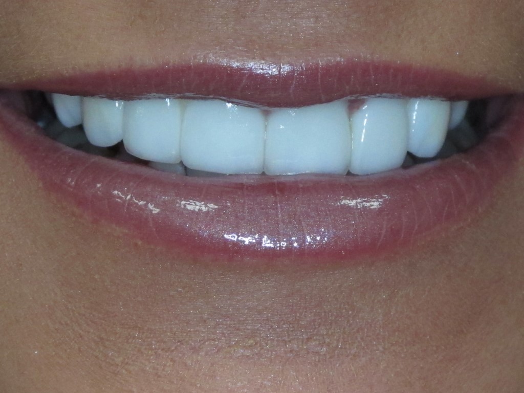 Porcelain Crowns / Veneers Smile Makeovers Dr. Andrew Willoughby