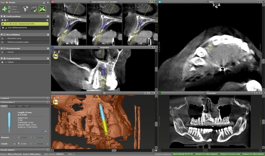 Patient TF - Diagnostix Digital Plan for CT guided placement of DI in area of missing tooth #22