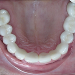 Upper Teeth Restored