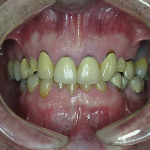 Upper teeth Before Severely broken down crowns and overclosed bite